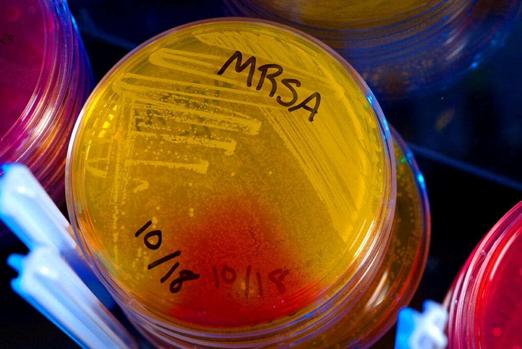 Antibiotic Overuse contributes to MRSA